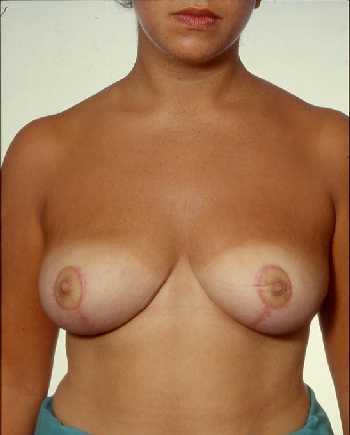 Breast Reduction Surgery