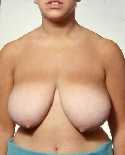 Breast Reduction Surgery