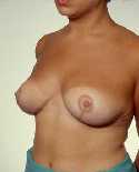 Breast Reduction Surgery