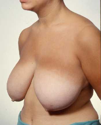 Breast Reduction Surgery