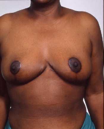 Breast Reduction Surgery