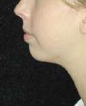 Chin Surgery