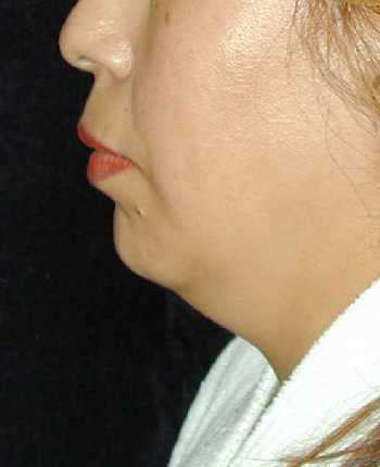 Chin Surgery