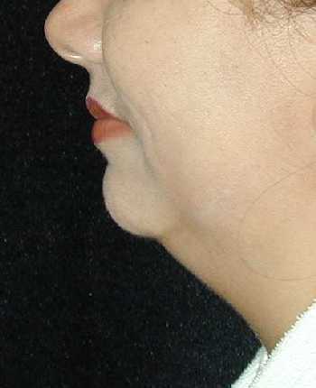 Chin Surgery