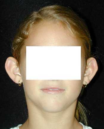 Ear Surgery