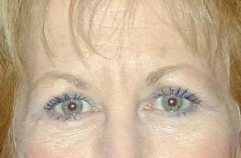 Eyelid Surgery