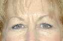 Eyelid (Blepharoplasty) Surgery