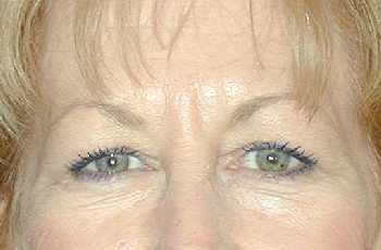 Eyelid Surgery