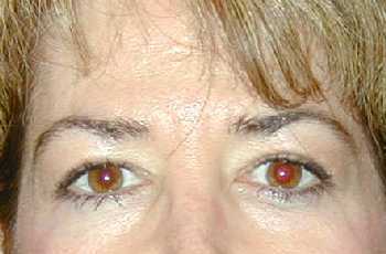 Eyelid Surgery