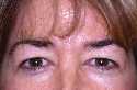 Eyelid (Blepharoplasty) Surgery