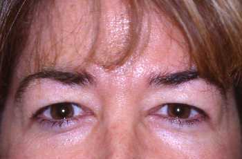 Eyelid Surgery