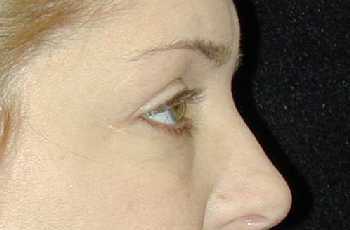 Eyelid Surgery