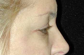 Eyelid Surgery