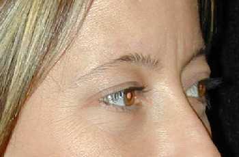 Eyelid Surgery