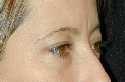 Eyelid (Blepharoplasty) Surgery