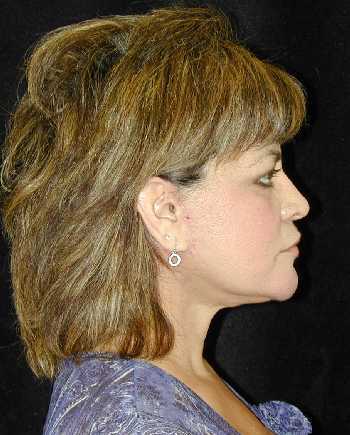 Facelift and Necklift