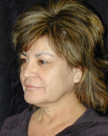 Facelift and Necklift