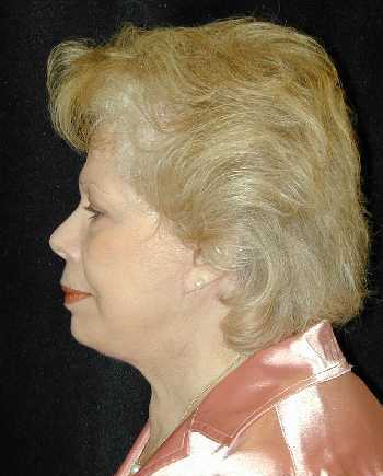 Facelift and Necklift