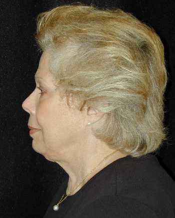 Facelift and Necklift