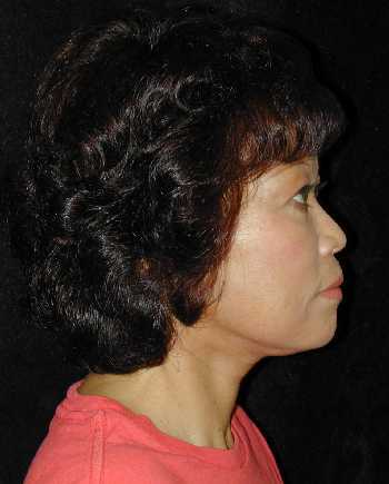 Facelift and Necklift