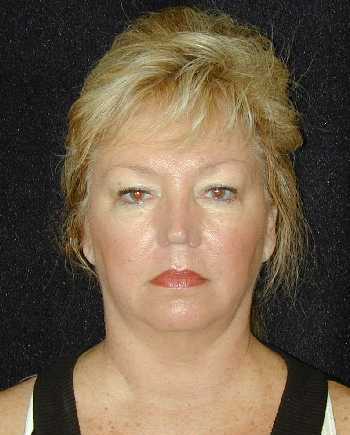 Facelift and Necklift