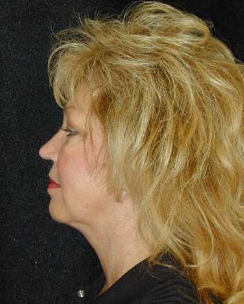 Facelift and Necklift