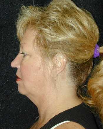 Facelift and Necklift