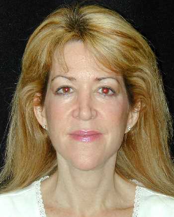 Facelift and Necklift