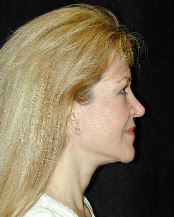 Facelift and Necklift