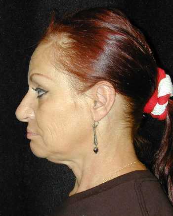 Facelift and Necklift