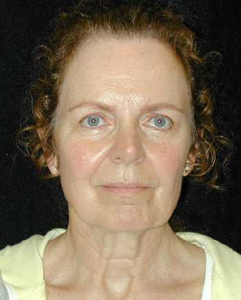 Facelift and Necklift