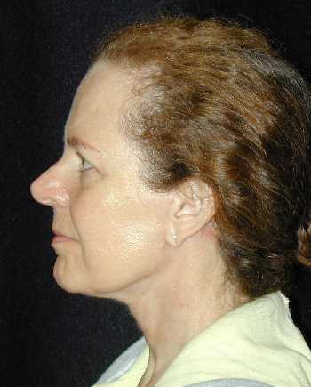 Facelift and Necklift