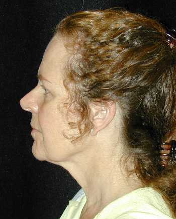 Facelift and Necklift