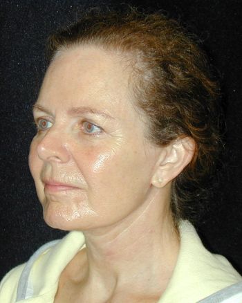 Facelift and Necklift