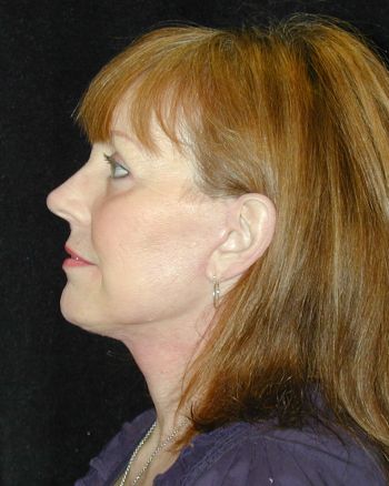 Facelift and Necklift