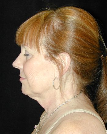 Facelift and Necklift