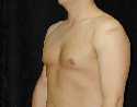 Gynecomastia Surgery