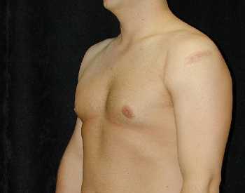 Gynecomastia (Male Breast) Surgery