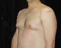 Gynecomastia Surgery