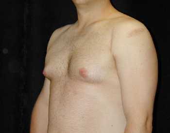 Gynecomastia (Male Breast) Surgery