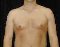 Gynecomastia Surgery