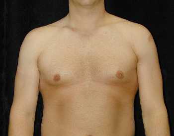 Gynecomastia (Male Breast) Surgery