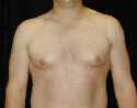 Gynecomastia Surgery