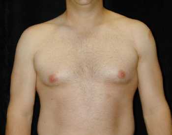 Gynecomastia (Male Breast) Surgery