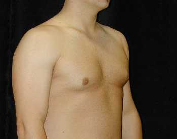 Gynecomastia (Male Breast) Surgery