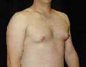 Gynecomastia Surgery