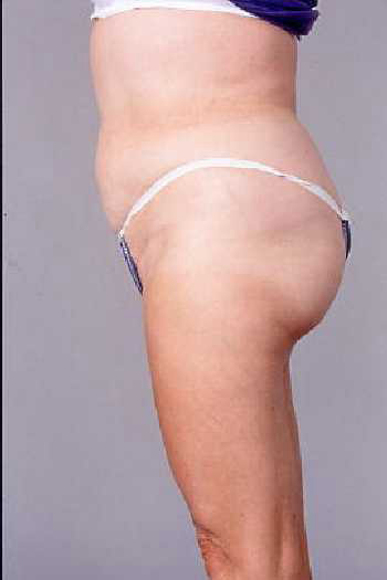 Liposuction Surgery