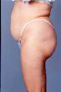 Liposuction Surgery