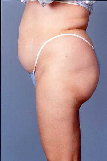 Liposuction Surgery