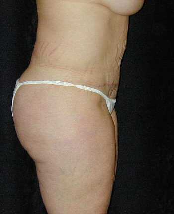 Tummy Tuck Surgery